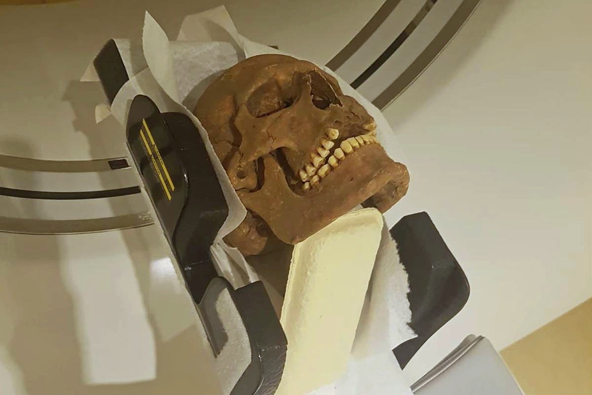 CT scans of Viking Age skulls, analyzed by researchers at the University of Gothenburg, showed widespread evidence of dental decay, infections, and severe tooth wear.