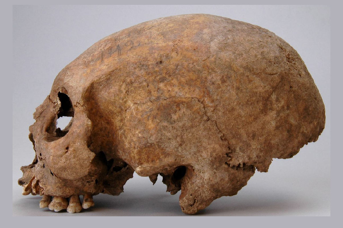 In the Viking Age, skull modification was rare, with only three female examples identified on Gotland.