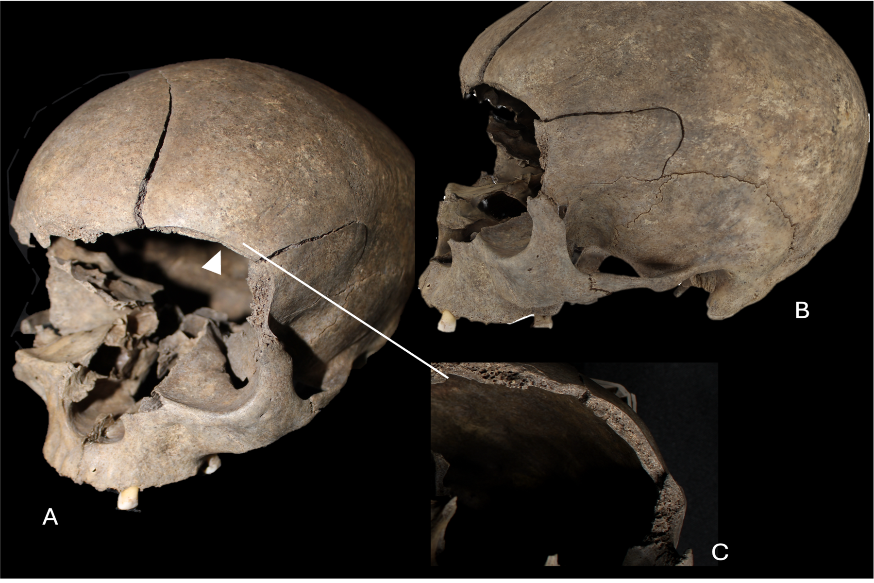 Skull of a Viking Age woman from near Aarhus. The skull bears traces of chop marks and was later deposited in a well. Source: National Museum of Denmark